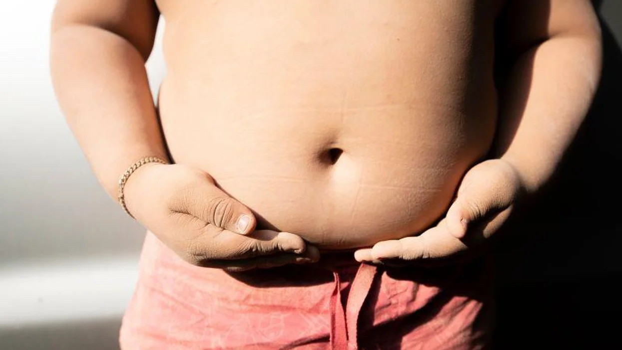 『米国小児の肥満発症は低年齢化が進む』のイメージ